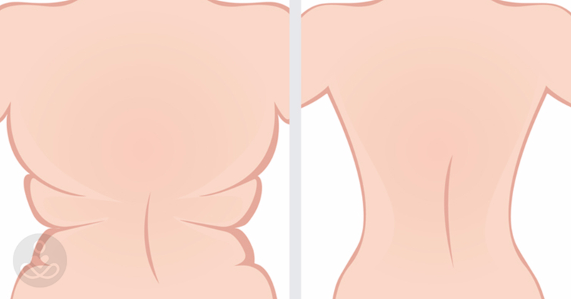 hogyan lehet eltávolítani a zsírt a hátból 14 hét lefogy